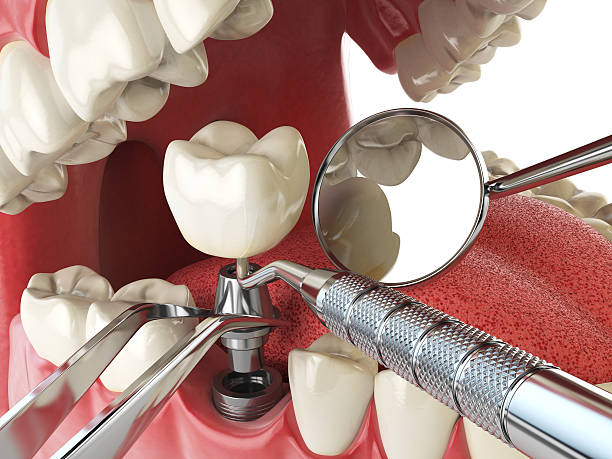 Best Emergency Root Canal Therapy in Albertson, NY